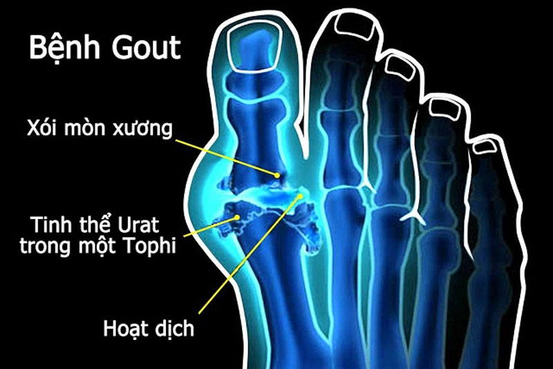 Tác dụng của nước điện giải ion đối với bệnh Gout