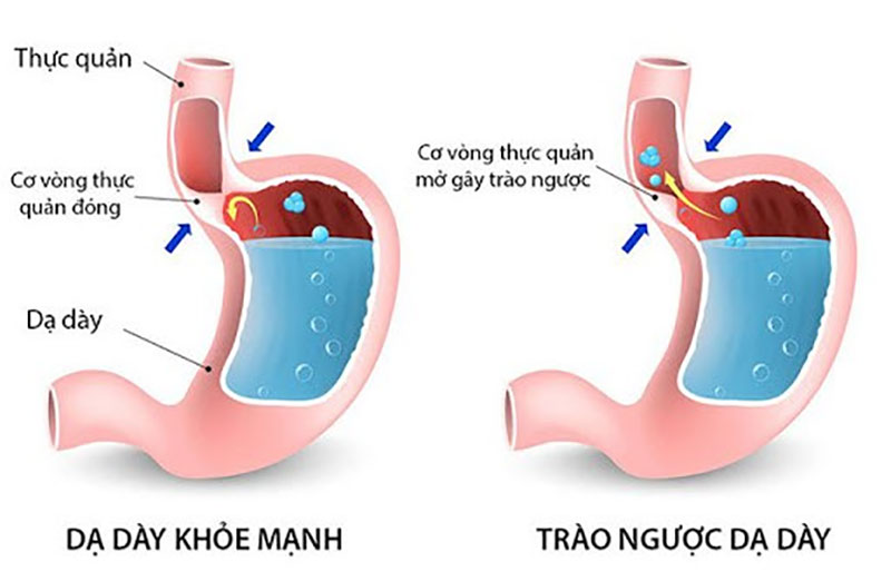 Công dụng của nước ion kiềm với chứng ợ nóng