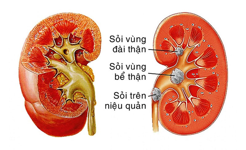 Các công dụng của nước ion kiềm đối với thận