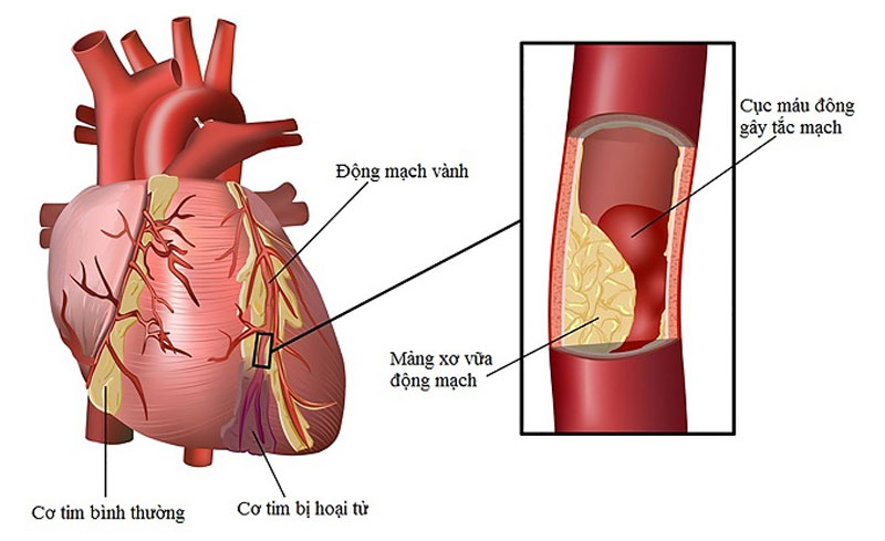 Biến chứng của bệnh máu nhiễm mỡ