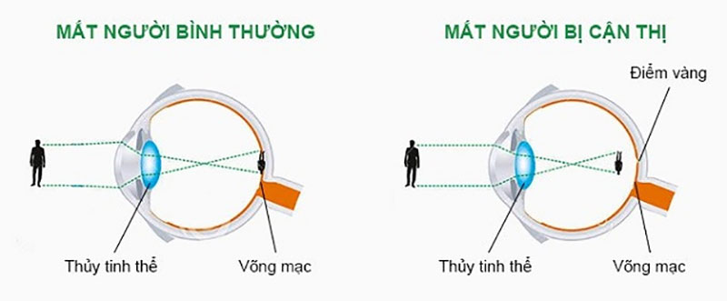 Nước ion kiềm và bệnh cận thị bạn nên biết