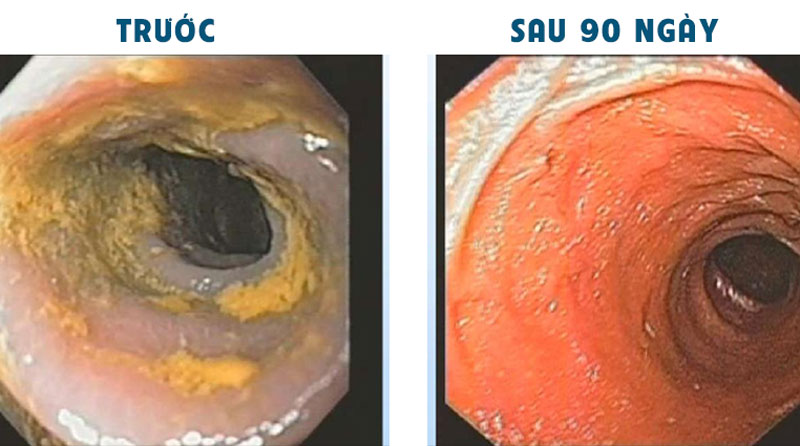 Các bằng chứng khoa học về hỗ trợ điều trị viêm đại tràng bằng nước ion kiềm